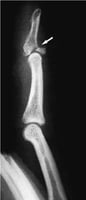 erythema and swelling of the distal interphalangeal (DIP) joint