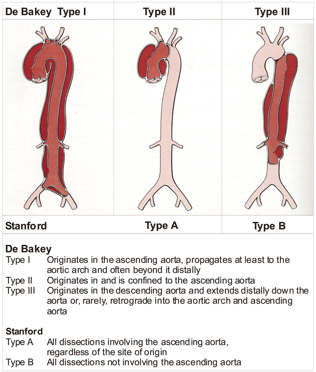 Aortic Dissection Classification