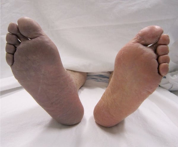 Cyanosis case - 80-year-old man with a history of diabetes mellitus presents with acute pain, cyanosis
