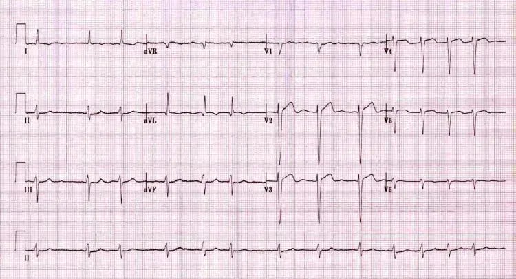 EKG