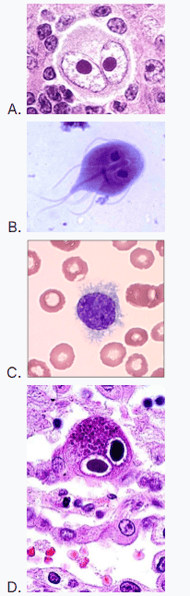 Hodgkin Lymphoma Biopsy