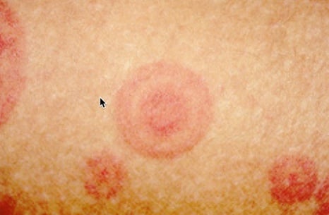 Immune Dysregulation- Hypersensitivity Reactions - Toddler with a diffuse rash, fever, and malaise case