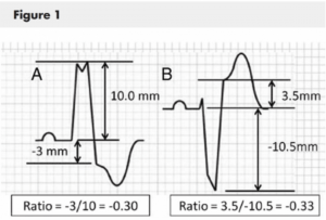 Acute Coronary Syndromes Case - Differentiation of LBBB from AMI