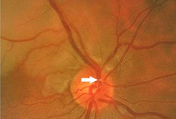 Eye Vascular Disorders of the Eye Amaurosis Fugax Case