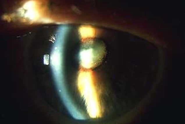 Glaucoma in woman with poorly controlled diabetes presents with unilateral eye pain and associated headache, nausea, and vomiting - Patient Case figure