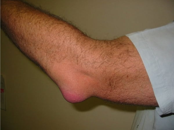 overuse syndrome versus septic joint, septic olecranon bursitis - challengercme.com