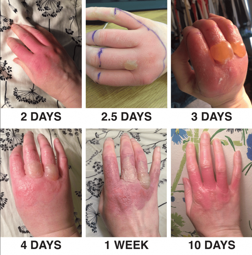 Photosensitivity Dermatoses, Phytophotodermatitis Stages