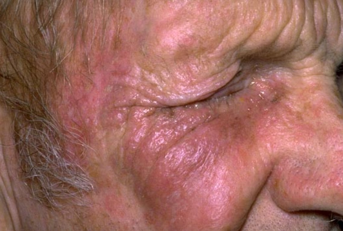 Viral Infections - Hutchinson Sign