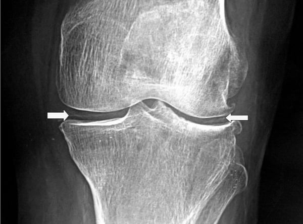 Inflammatory disorders of joints case