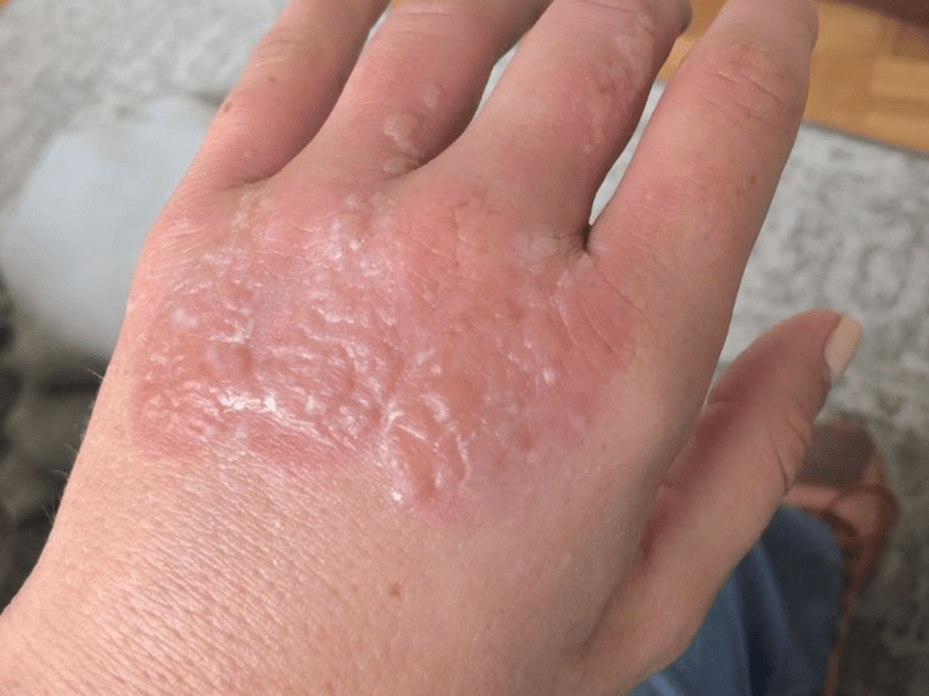 Margarita Burn - Photosensitivity Dermatoses, Phytophotodermatitis