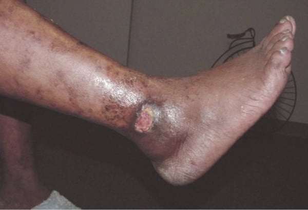 Vascular Dermatoses - Ulceration On Lower Extremity After Mild Trauma - Clinical Patient Case of the Week