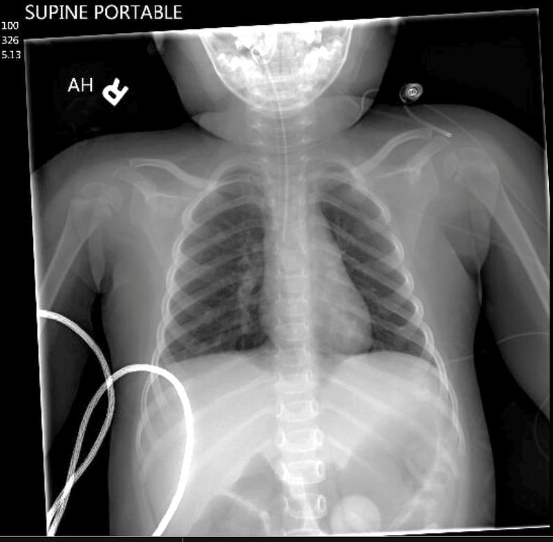 Intubation