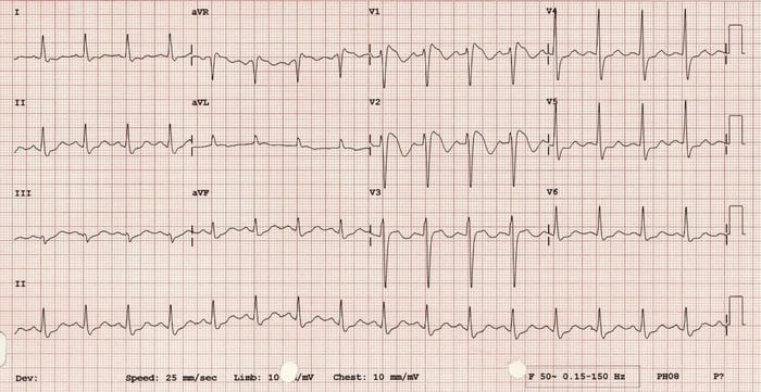 Most Missed FM Brugada Syndrome