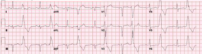 Most Missed Family Medicine ECG Septal Infarct vs STEMI