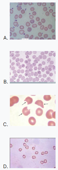 Most Missed IM - Lead Poisoning