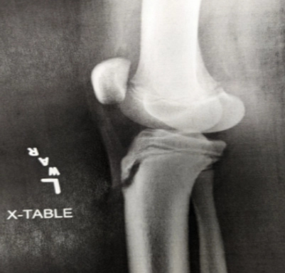 Osgood–Schlatter Disease