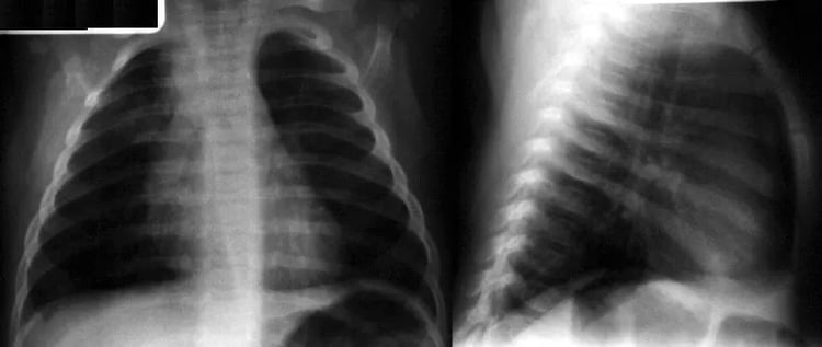 Pediatrics - Community-Acquired Pneumonia