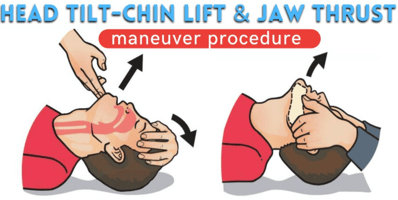 Peds EM: Trauma Airway – Jaw Thrust vs Head Tilt