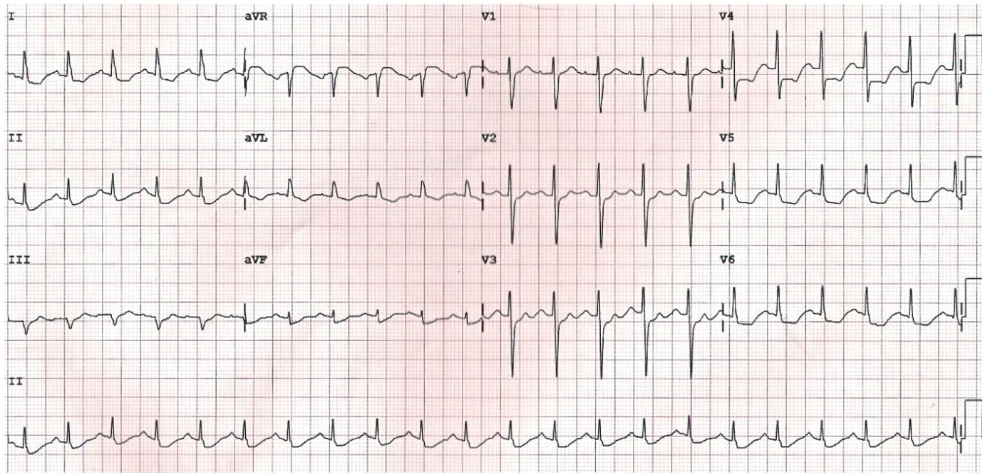 QQ230515 Non-ST-Elevation Acute Coronary Syndromes - Surgical Invasive Management case
