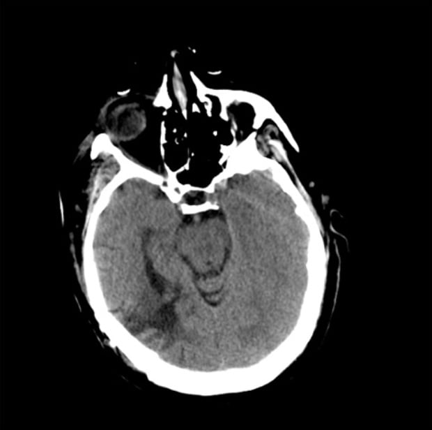 Seizure Disorders figure - New Onset Seizure in Patient with Cancer
