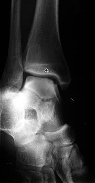 Twisted Ankle with Edema and Tenderness - Patient Case of the Week - figure1