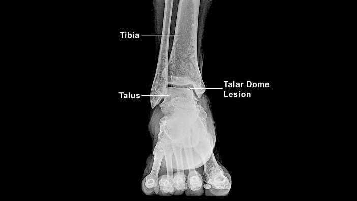 Twisted Ankle with Edema and Tenderness - Patient Case of the Week - figure2