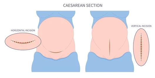 c section ABOG EXAM