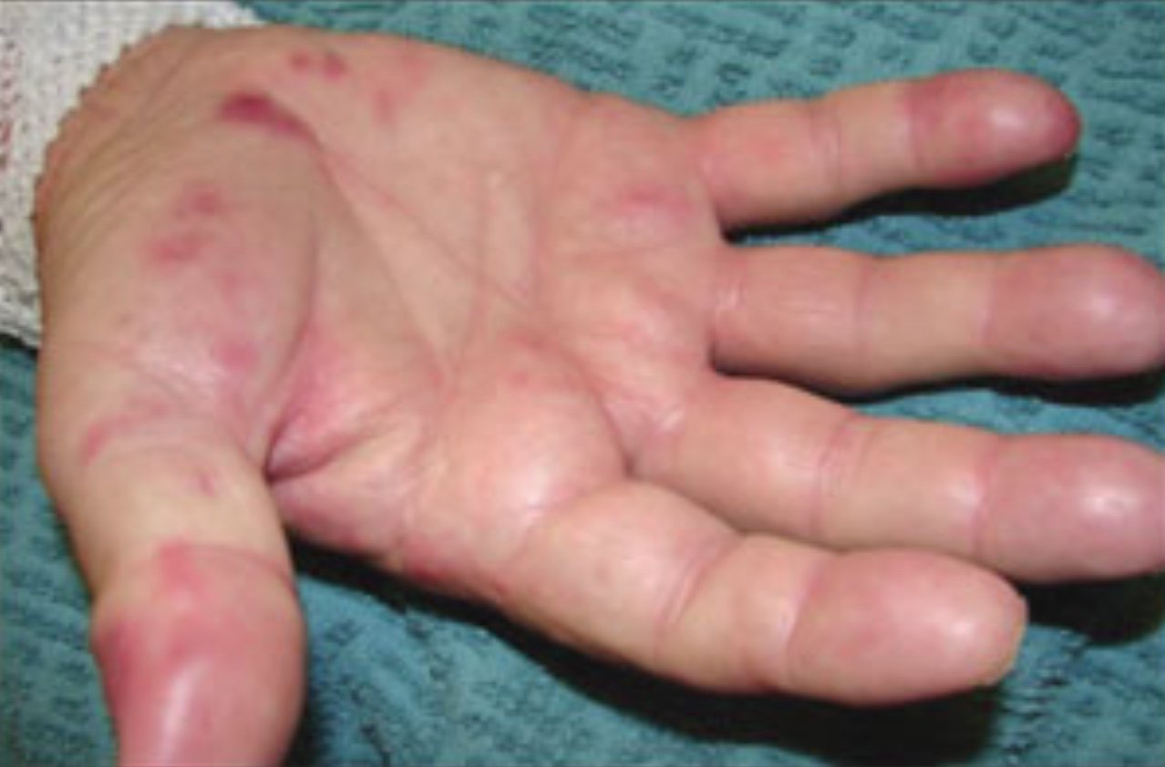 foci of tenderness and discoloration on the palmar surface of his hand and fingers