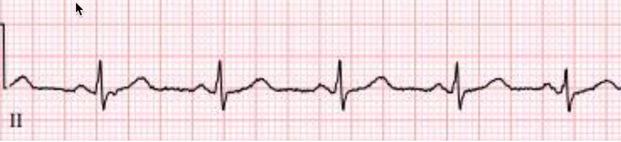 14 year-old girl, pulseless, CPR ongoing