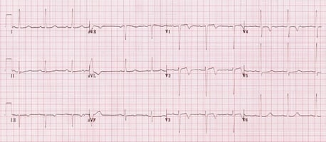 A 60-year-old woman with a history of hypertension and diabetes