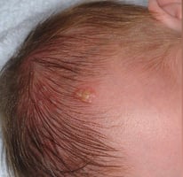 10 day old neonatal girl presents with parents with concern for a rash along her scalp