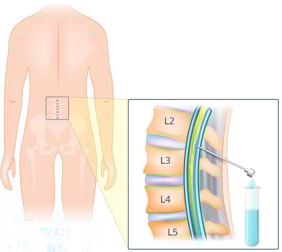 lumbar-puncture-a40f55