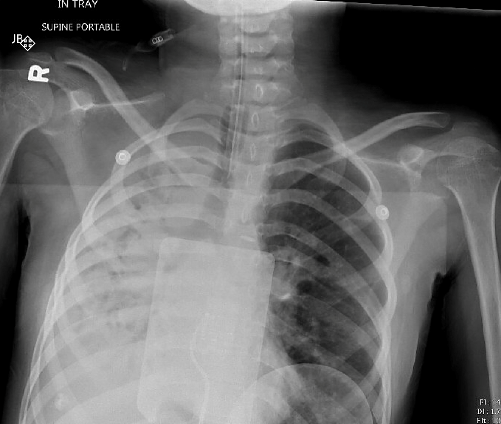 13 yo adolescent girl with history of myotonic dystrophy presents with a 2 day history of cough, nasal congestion, and several episodes of non-bloody nonbilious emesis presents in respiratory distress. 