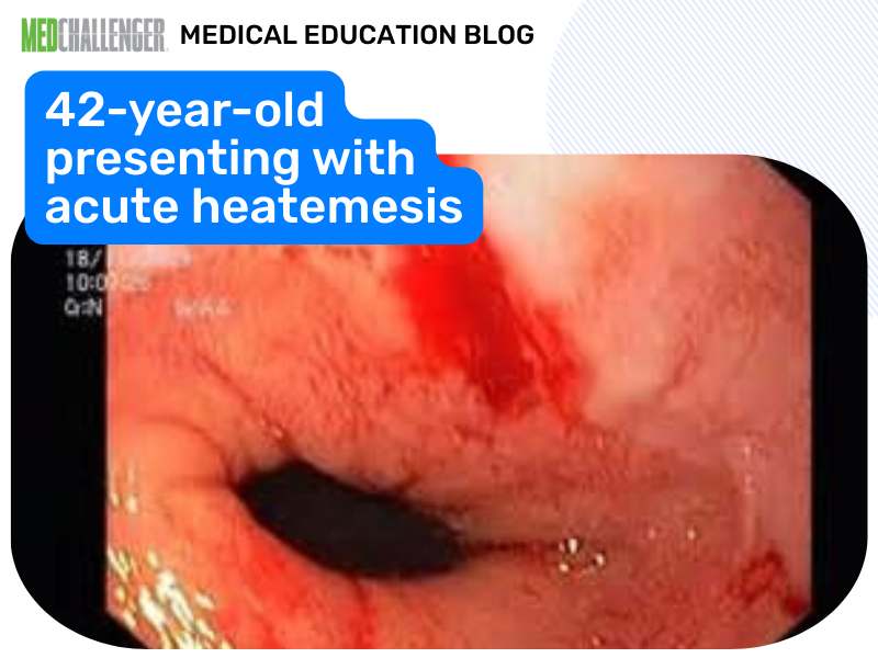 acute heatemesis quiz time