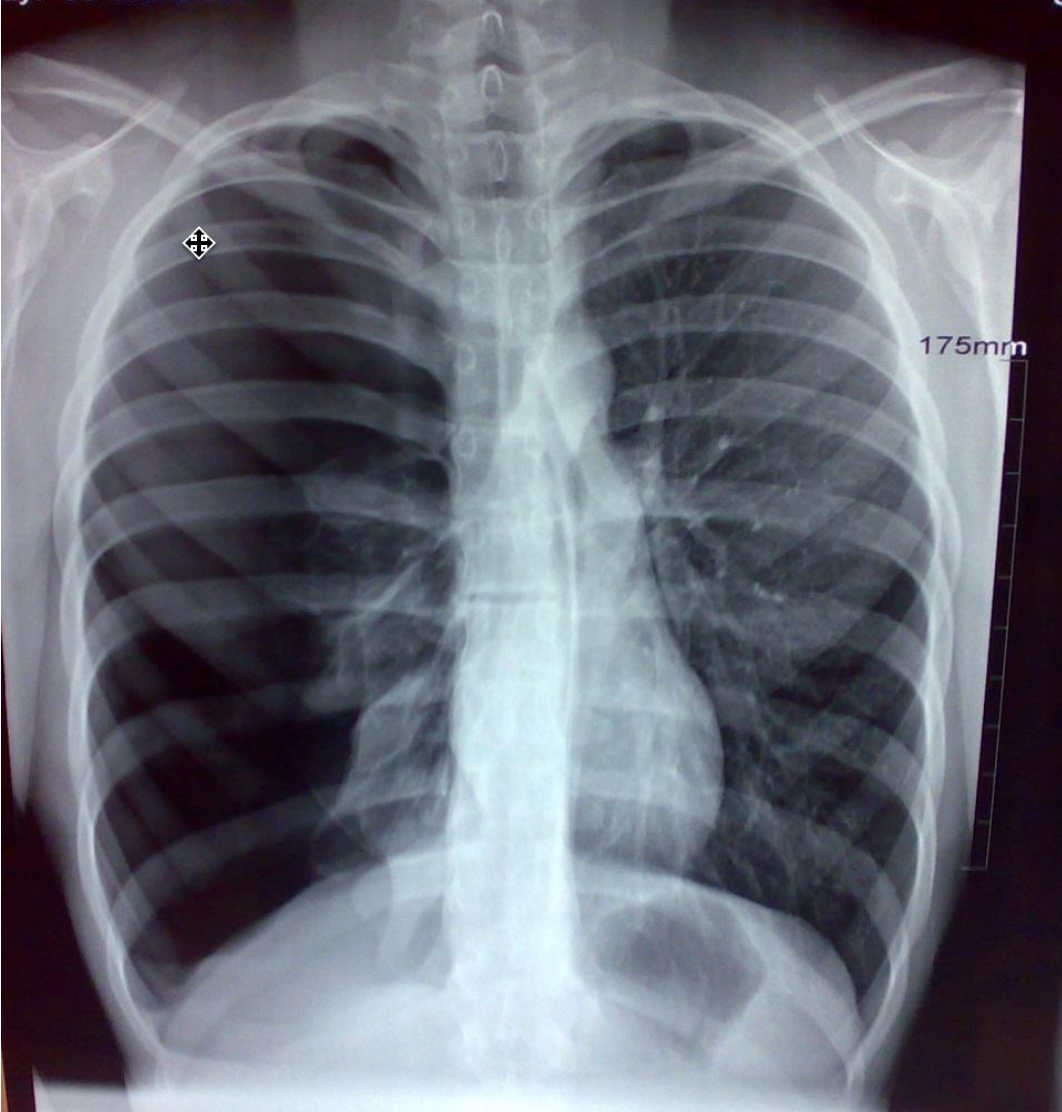 Describe possible radiological findings on CXR in a patient who presents with respiratory distress after smoking cocaine