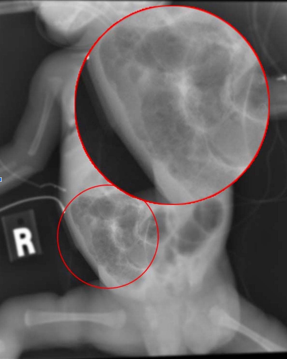 Discuss radiological diagnosis of necrotizing enterocolitis