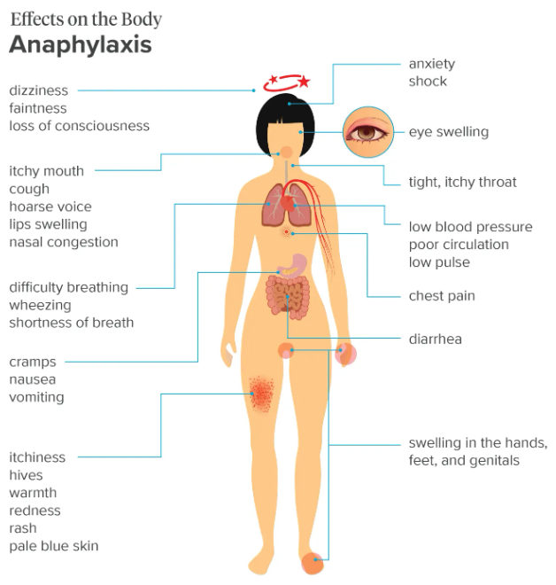 Effects of Anaphylaxis on the Body
