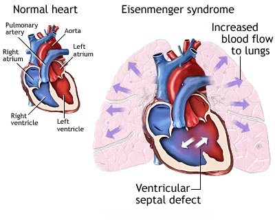 Which of the following congenital heart lesions, if left untreated, is most likely to lead to Eisenmenger syndrome?