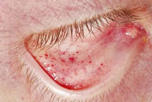 Which of the following essentially confirm a diagnosis of bacterial endocarditis in this febrile patient?
