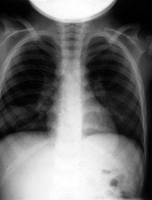 RUQ pain with fever 1