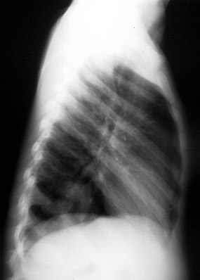 RUQ pain with fever 2