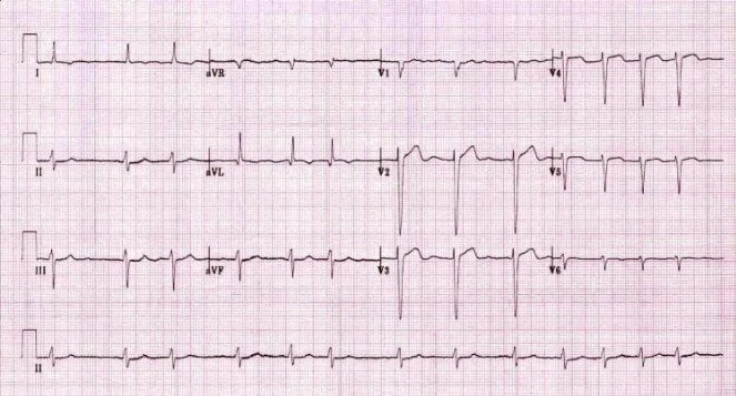 #1 Missed Question in EM This Week 030125