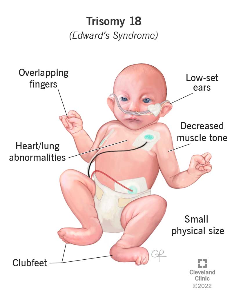Most Missed: Trisomy 18 Risk Factors (Pediatrics)