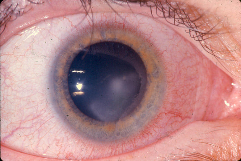 20-year-old woman in MVC with burning sensation in eyes