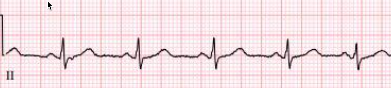 14 year-old girl, pulseless, CPR ongoing