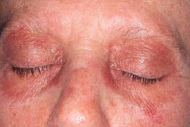 60 year-old female with painless non-pruritic rash