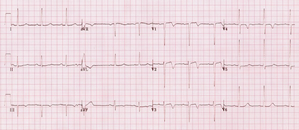 A 60-year-old woman with a history of hypertension and diabetes