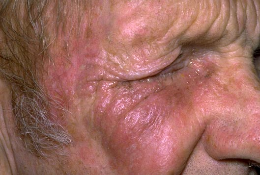 83-year-old man presents to you with new-onset vesicular rash