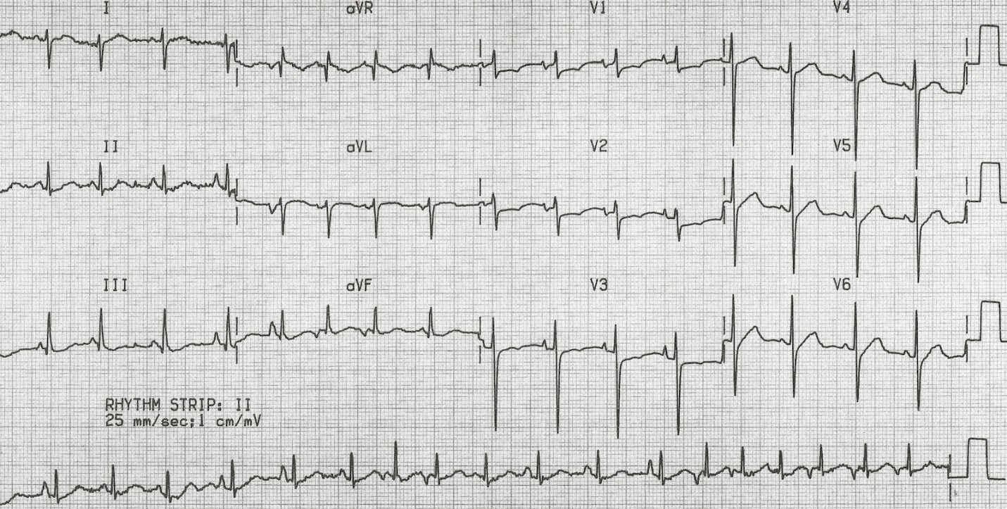 55-year-old man with a history of COPD and hypertension