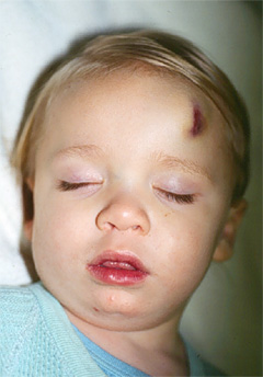 18-month-old boy with severe hemophilia A